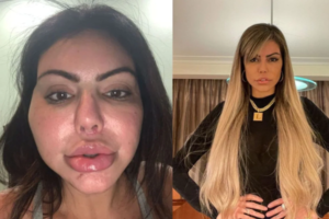 Harmonizações faciais que deram errado e os MOTIVOS por trás