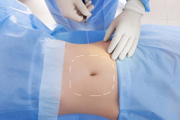 Endolaser abdominal: tudo sobre procedimento contra flacidez e gordura localizada